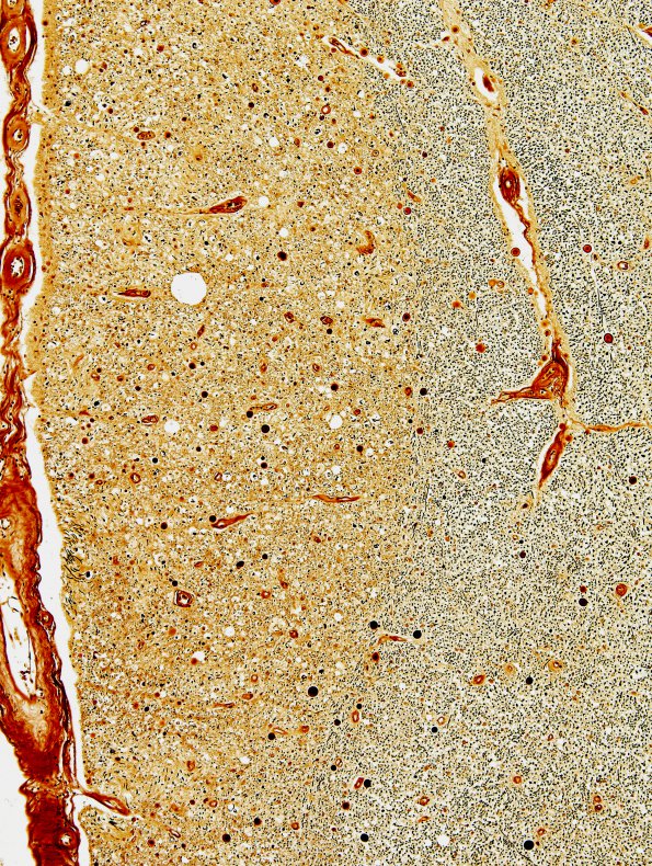 4E7 Lymphoma, IV (Case 4) myelitis N10 Dorsal column Biels 2