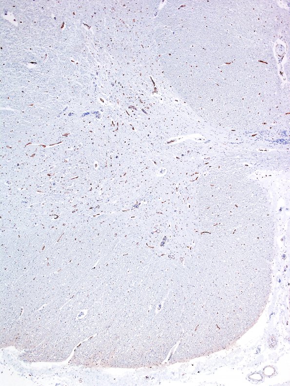 4F3 Lymphoma, IV (Case 4) myelitis N10 CD34 15