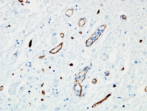 4F4 Lymphoma, IV (Case 4) myelitis N10 CD34 13