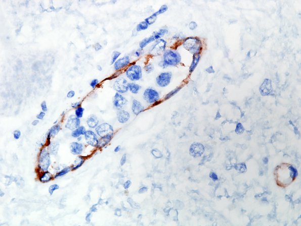 4F5 Lymphoma, IV (Case 4) myelitis N10 CD34 5