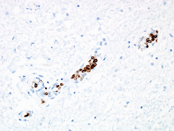 4F6 Lymphoma, IV (Case 4) myelitis N10 Ki67 4