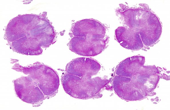 4G1 Lymphoma, IV (Case 4) myelitis N13 1 H&E whole mount (backup)