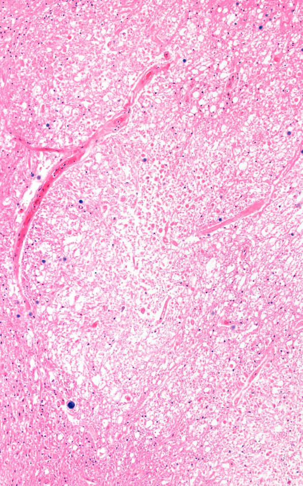 4G3 Lymphoma, IV (Case 4) myelitis N13 1 H&E 10X 3