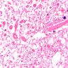 4G4 Lymphoma, IV (Case 4) myelitis N13 1 H&E 40X