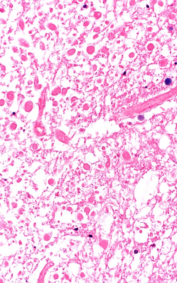 4G4 Lymphoma, IV (Case 4) myelitis N13 1 H&E 40X