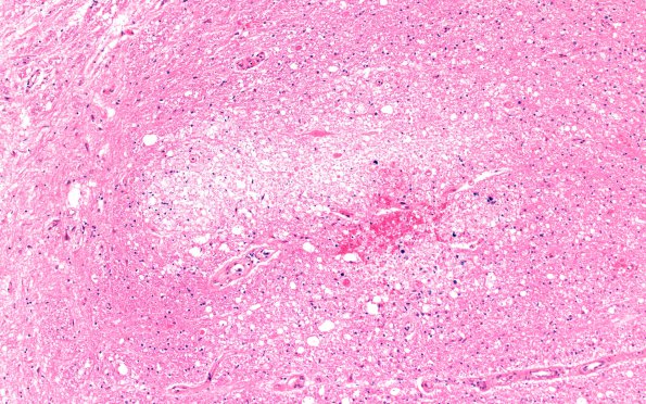 4G5 Lymphoma, IV (Case 4) myelitis N13 1 H&E 10X 4