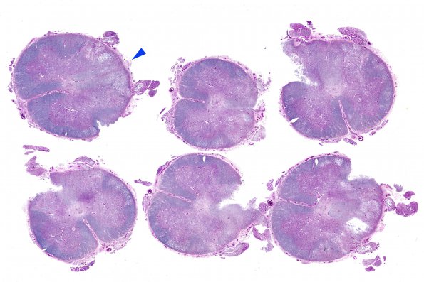 4H1 Lymphoma, IV (Case 4) myelitis N13 1 LFB-PAS whole mount copy