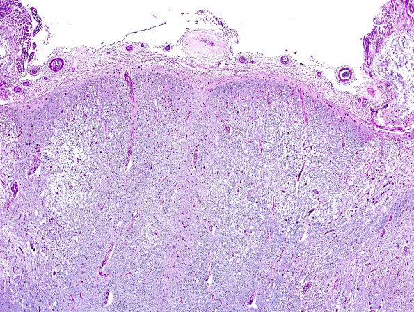 4H2 Lymphoma, IV (Case 4) myelitis N13 LFB-PAS 1