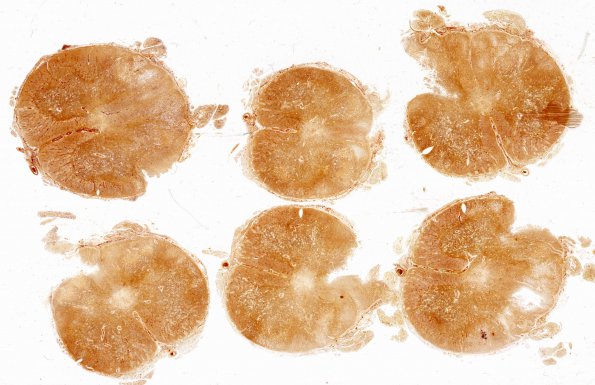 4I1 Lymphoma, IV (Case 4) myelitis N13 1 Biels whole mount