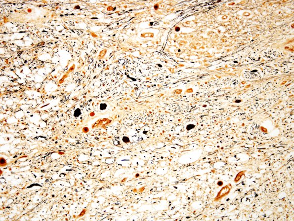 4I3 Lymphoma, IV (Case 4) myelitis N13 Biels 3