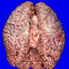 5A1 Lymphoma, IV (Case 5) _2