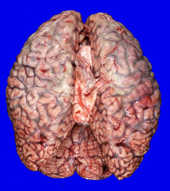 5A1 Lymphoma, IV (Case 5) _2