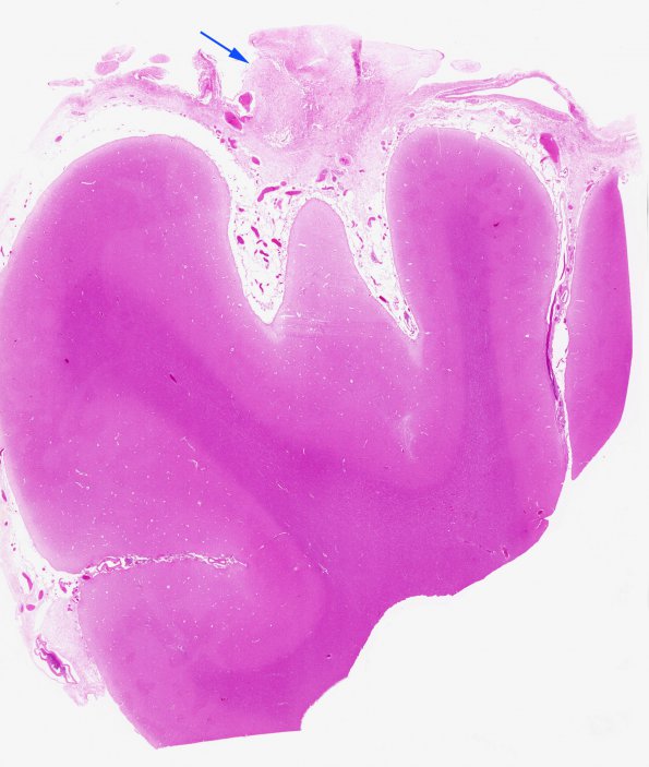 5A2 Leptomeningeal fibrosis (Case 5) H&E whole mount copy