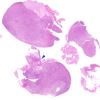 5B1 Pituitary Intravascular Lymphoma (Case 5) H&E whole mount copy