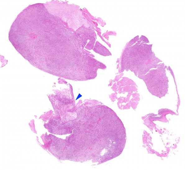 5B1 Pituitary Intravascular Lymphoma (Case 5) H&E whole mount copy