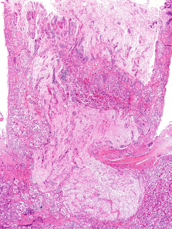 5B2 Lymphoma, IV (Case 5) H&E 9