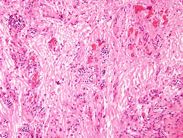 5B3 Lymphoma, IV (Case 5) H&E 4 (2)