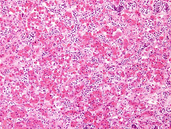 5B4 Lymphoma, IV (Case 5) H&E 2 (2)