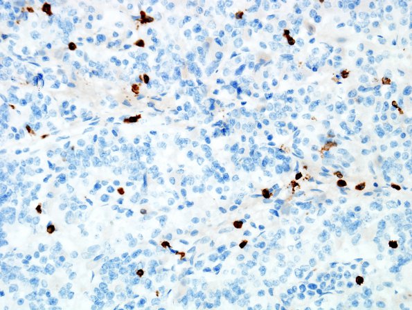 5C3 Lymphoma, IV (Case 5) CD3 1