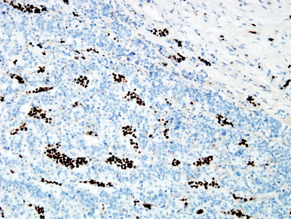 5C5 Lymphoma, IV (Case 5) Ki67 2