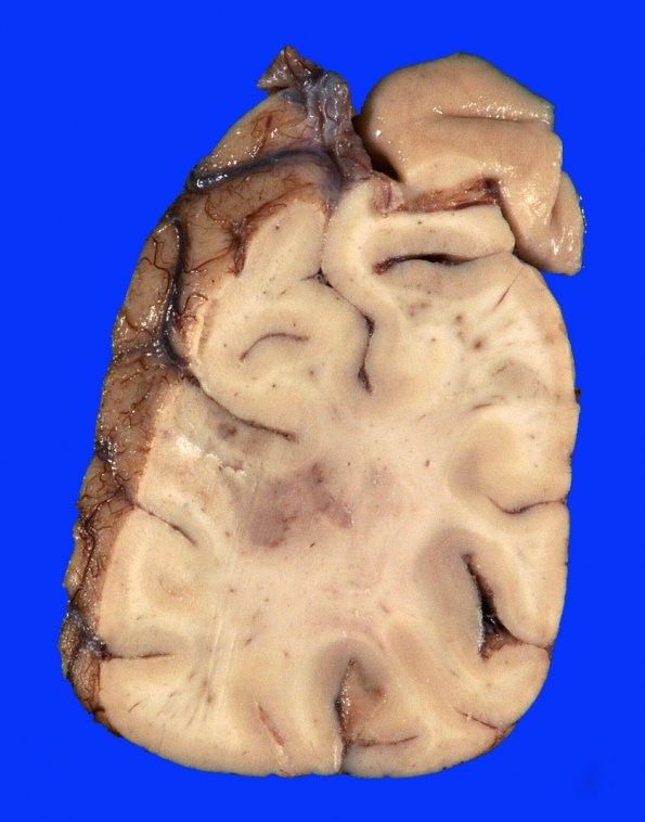 6A4 Lymphoma, IV (Case 6) 26