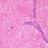 6B2 Lymphoma, IV (Case 6) 1 H&E 7