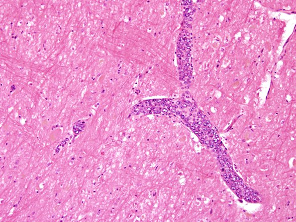 6B2 Lymphoma, IV (Case 6) 1 H&E 7