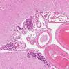 6B3 Lymphoma, IV (Case 6) 1 H&E 3