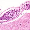 6B4 Lymphoma, IV (Case 6) 1 H&E 23