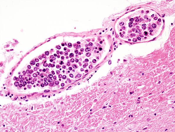 6B4 Lymphoma, IV (Case 6) 1 H&E 23