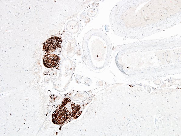 6C2 Lymphoma, IV (Case 6) 1 CD20 3