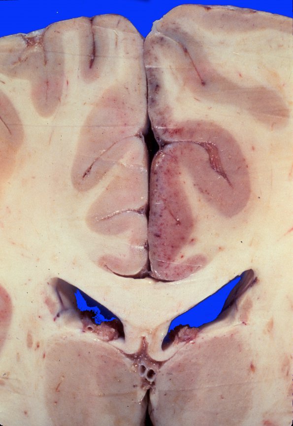 7A1 Infarct, recent, ACA (Case 7)