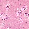 7B2 Lymphoma, Intravascular (Case 7) 4