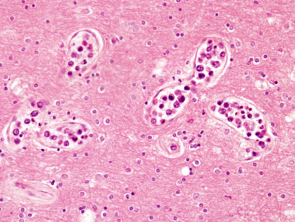 7B2 Lymphoma, Intravascular (Case 7) 4