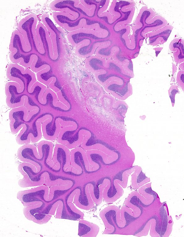 7B3 Lymphoma, Intravascular (Case 7) H&E whole mount 1