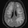 8A1 Lymphoma, large B-cell IV (Case 8) TIRM 1 - Copy