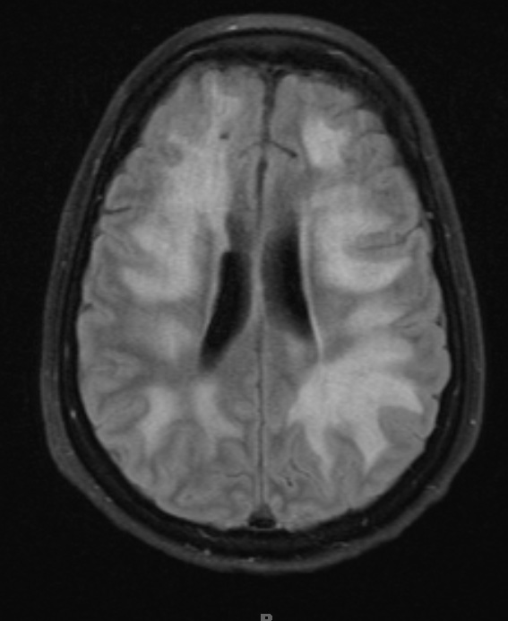 8A1 Lymphoma, large B-cell IV (Case 8) TIRM 1 - Copy