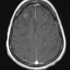 8A2 Lymphoma, large B-cell IV (Case 8) T1 W 1 - Copy