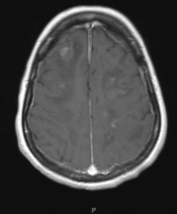 8A2 Lymphoma, large B-cell IV (Case 8) T1 W 1 - Copy