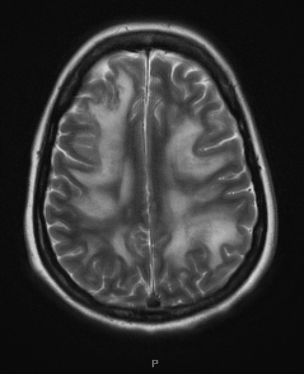 8A3 Lymphoma, large B-cell IV (Case 8 T2 W 1 - Copy