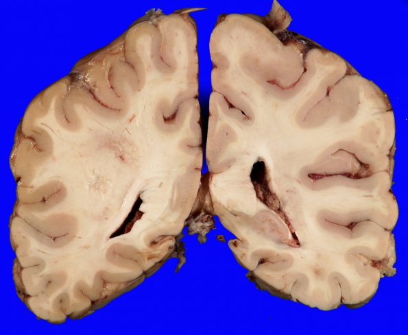 8B2 Lymphoma, Large B-cell IV (Case 8) 7