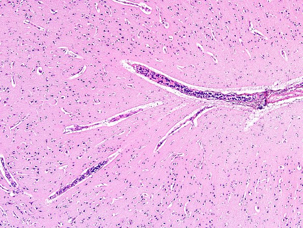 8C2 Lymphoma, Large B-cell IV (Case 8) N1 H&E 5