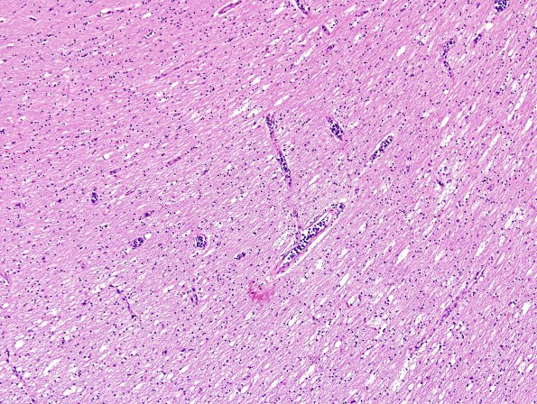 8C3 Lymphoma, Large B-cell IV (Case 8) N1 H&E 4