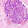 8C4 Lymphoma, Large B-cell IV (Case 8) H&E 2