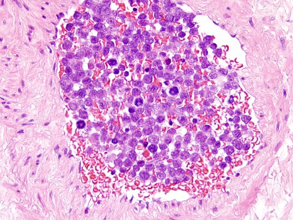 8C4 Lymphoma, Large B-cell IV (Case 8) H&E 2