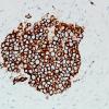 8C5 Lymphoma, Large B-cell IV (Case 8) CD20