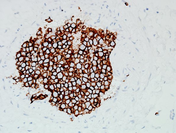 8C5 Lymphoma, Large B-cell IV (Case 8) CD20