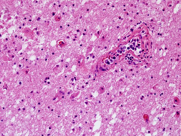 8D3 Lymphoma, Large B-cell IV (Case 8) Centrum Semiovale H&E 7