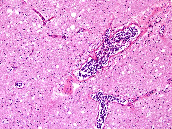 8D4 Lymphoma, Large B-cell IV (Case 8) Centrum Semiovale H&E 10