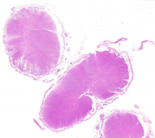 8E1 Lymphoma, Large B-cell IV (Case 8) N10 H&E whole mount